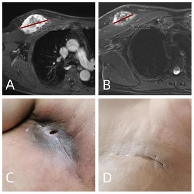 Preoperative sequential chemotherapy and hypofractionated radiotherapy combined with comprehensive surgical resection for high-risk soft tissue sarcomas: a retrospective study